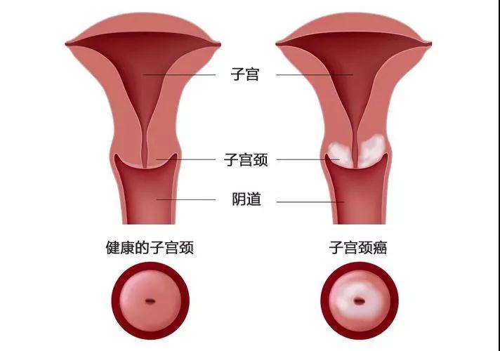 宫颈糜烂可以分为生理现象和病理异常,生理宫颈糜烂是正常现象,不用治