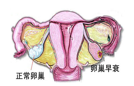 女性千万不要滥用紧急避孕药,小心卵巢早衰