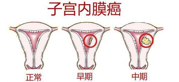 子宫内膜癌的护理方法