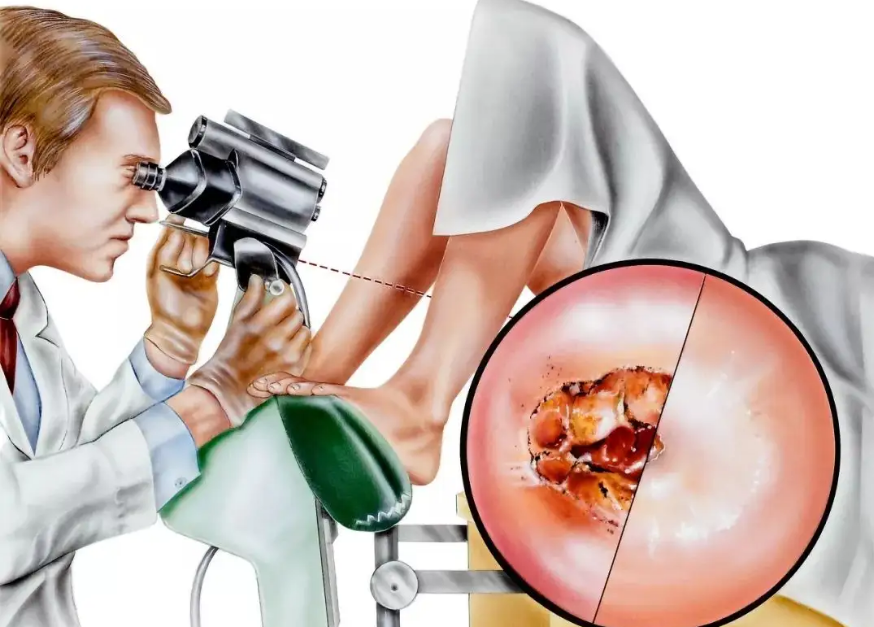 宫颈糜烂放药过程图片图片