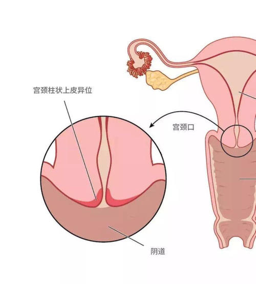 女人宫颈肥大图片图片