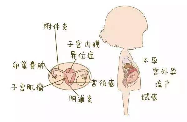 2,受精卵难以在有炎症的子宫内膜上着床,导致不孕3,即使