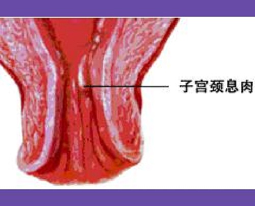 宫颈息肉谁做了谁后悔图片